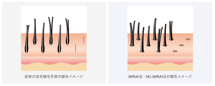 親和クリニックの自毛植毛イメージ